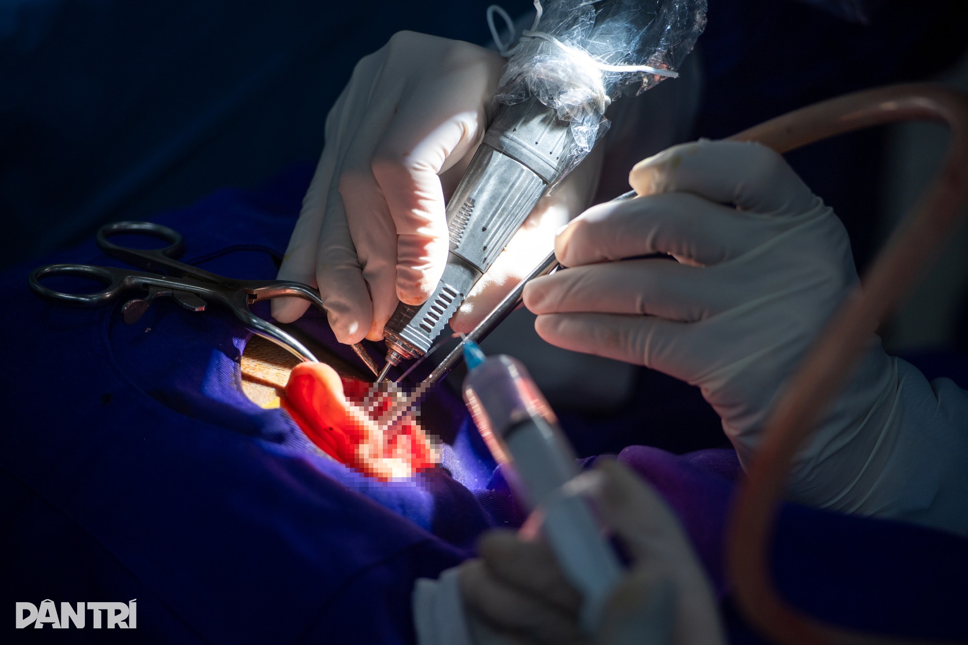 Hồi hộp xem bác sĩ cấy tai máy mang thanh âm cho em bé khiếm thính - 12