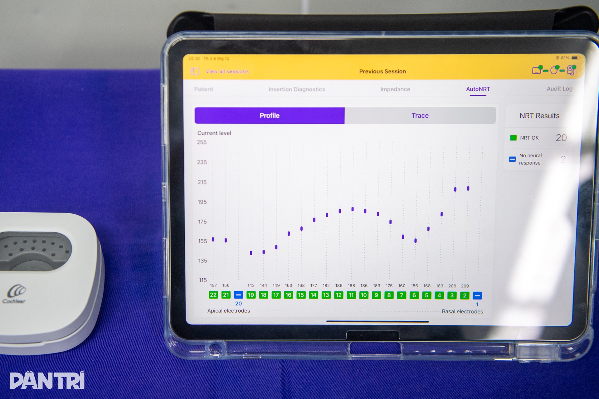 Hồi hộp xem bác sĩ cấy tai máy mang thanh âm cho em bé khiếm thính - 17