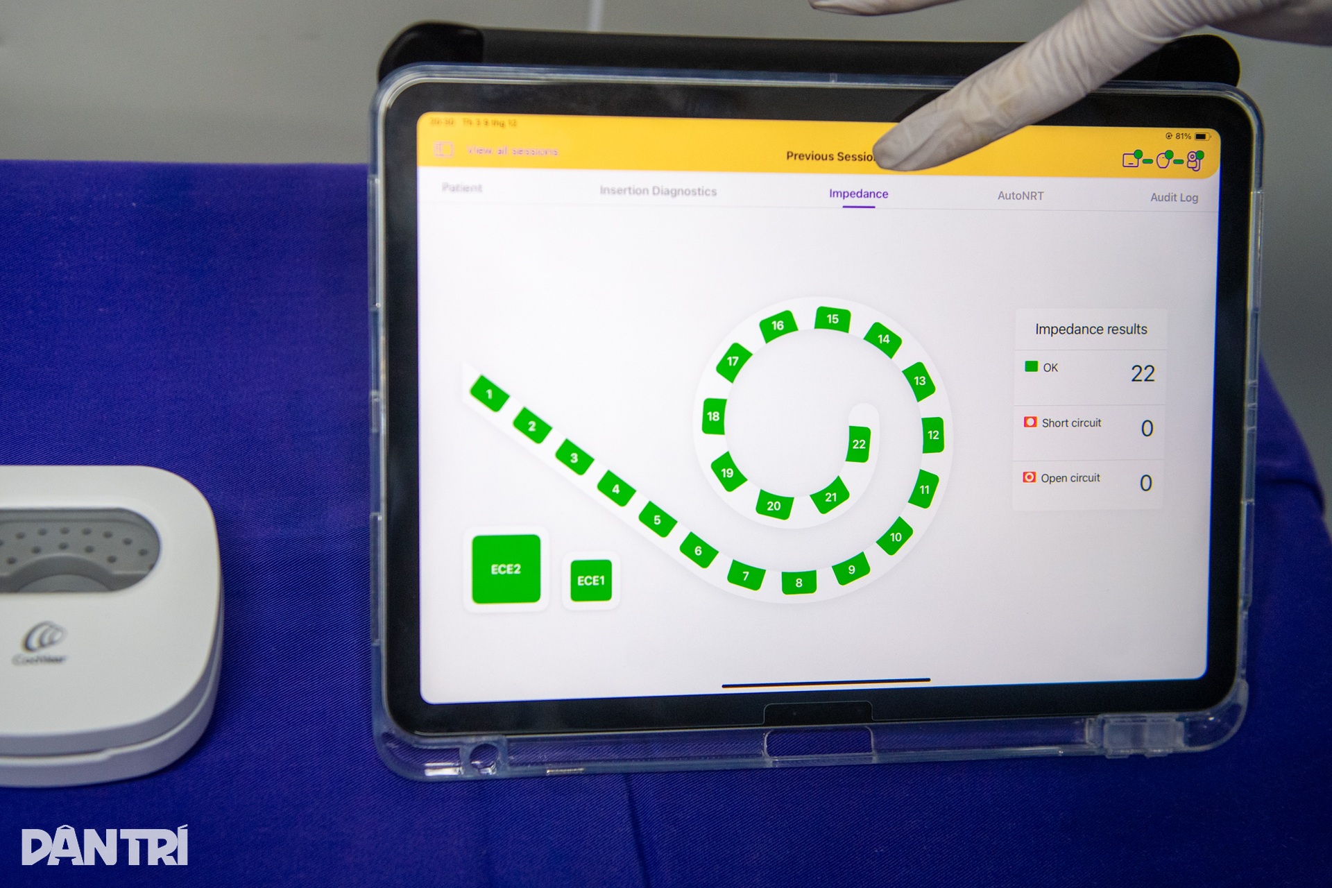 Hồi hộp xem bác sĩ cấy tai máy mang thanh âm cho em bé khiếm thính - 18