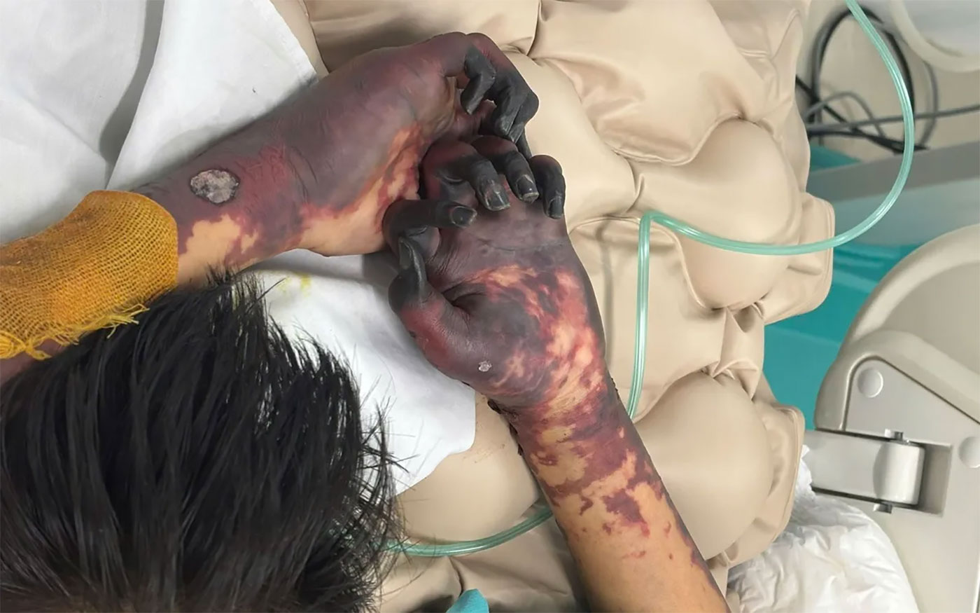 Nỗi đau người mẹ khi con trai cầu thủ cắt bỏ chân vì bệnh não mô cầu 4 Nỗi đau người mẹ khi con trai cầu thủ cắt bỏ chân vì bệnh não mô cầu - Ảnh 4.