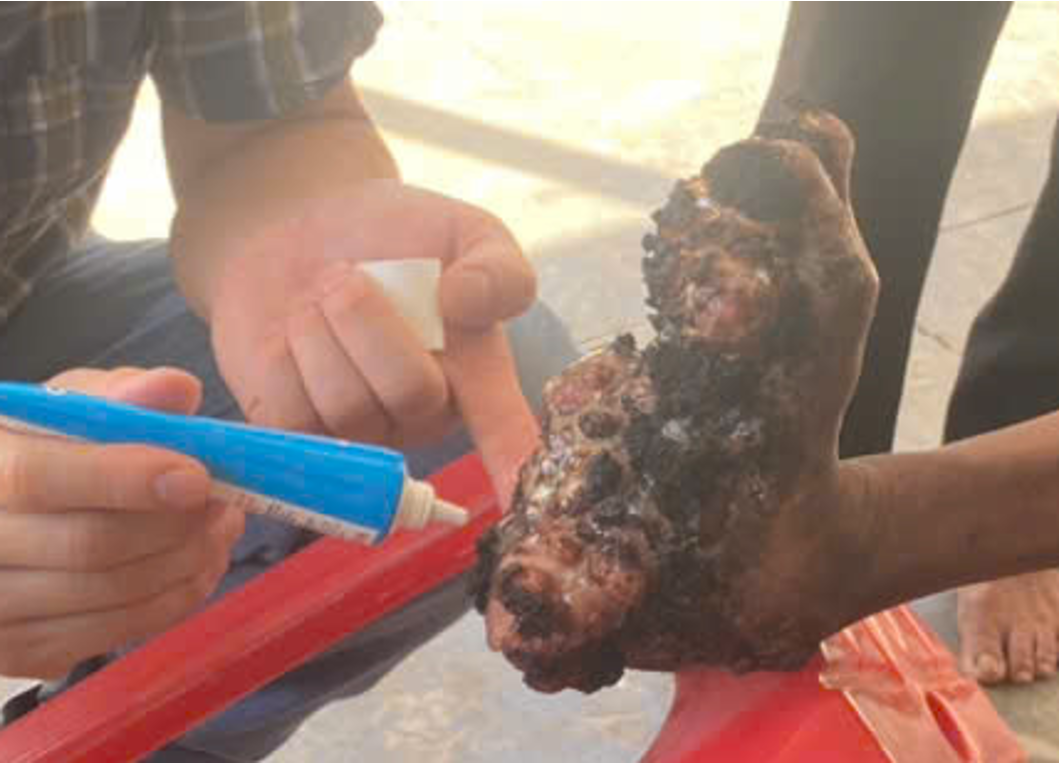 Giải mã bí ẩn bệnh “người cây” hiếm gặp tại Việt Nam - Ảnh 3.