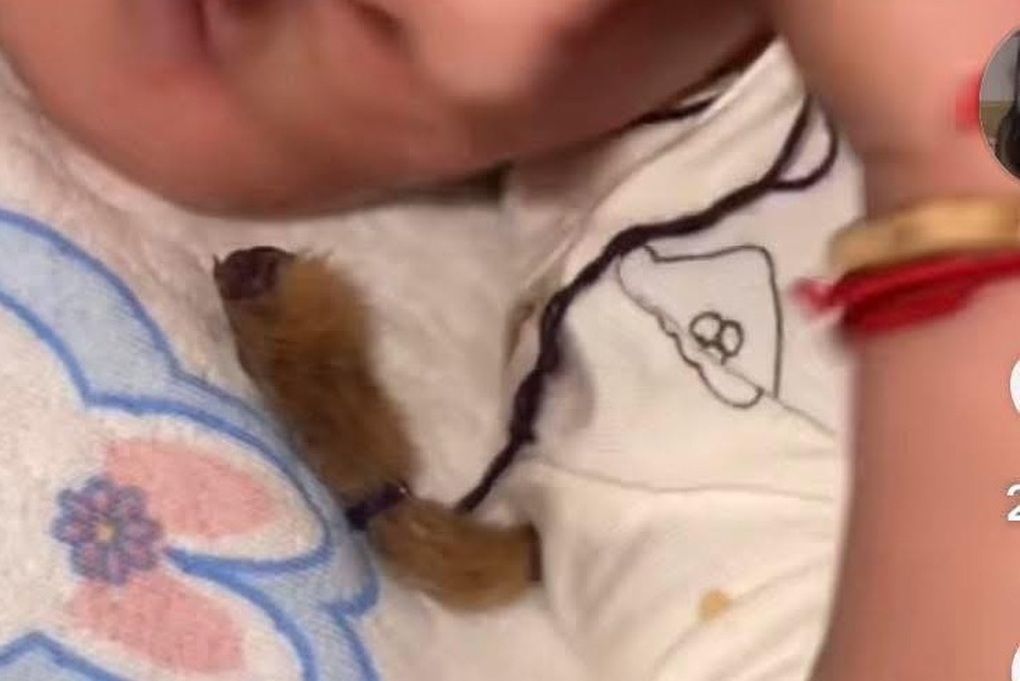 Xôn xao việc cho trẻ ngậm “tay khỉ khô đầy lông” để... ngừa bệnh cam - 2