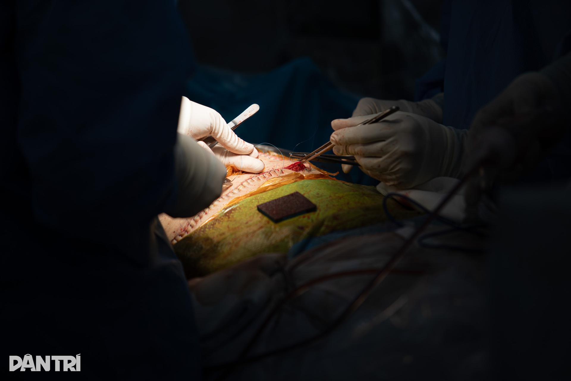 Xuyên đêm ghép gan, bác sĩ quân y giành lại sự sống cho bệnh nhân - 18