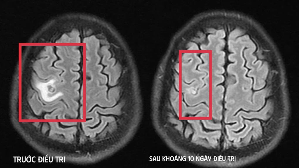 Sán làm tổ trong não khiến người đàn ông co giật: Nguồn lây quen thuộc - 2