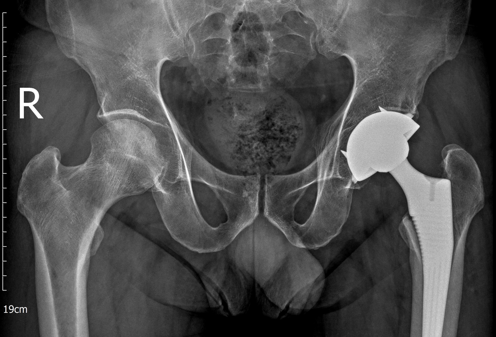 Tưởng chừng phải nằm một chỗ, nam bệnh nhân tự đi lại sau 48 giờ thay khớp háng - 3