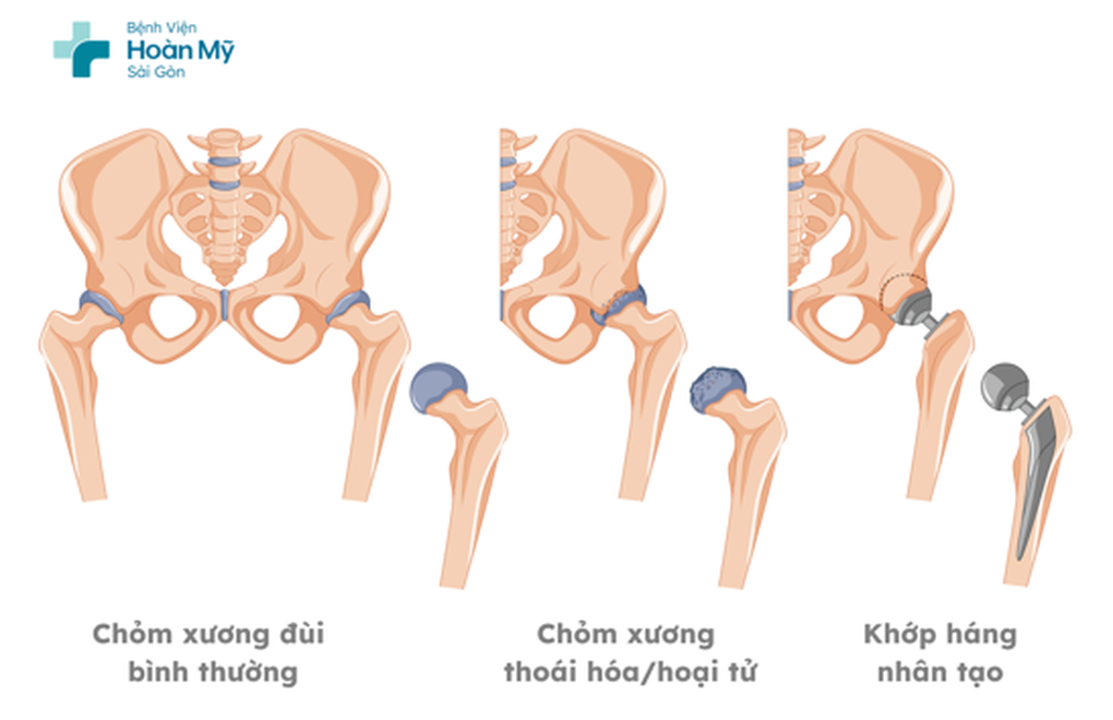 Tưởng chừng phải nằm một chỗ, nam bệnh nhân tự đi lại sau 48 giờ thay khớp háng - 4