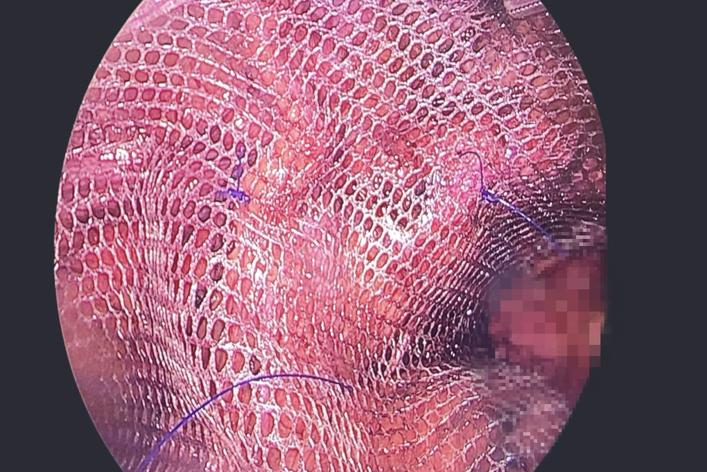 Căn bệnh ở vùng kín khiến người đàn ông suýt hoại tử - 2