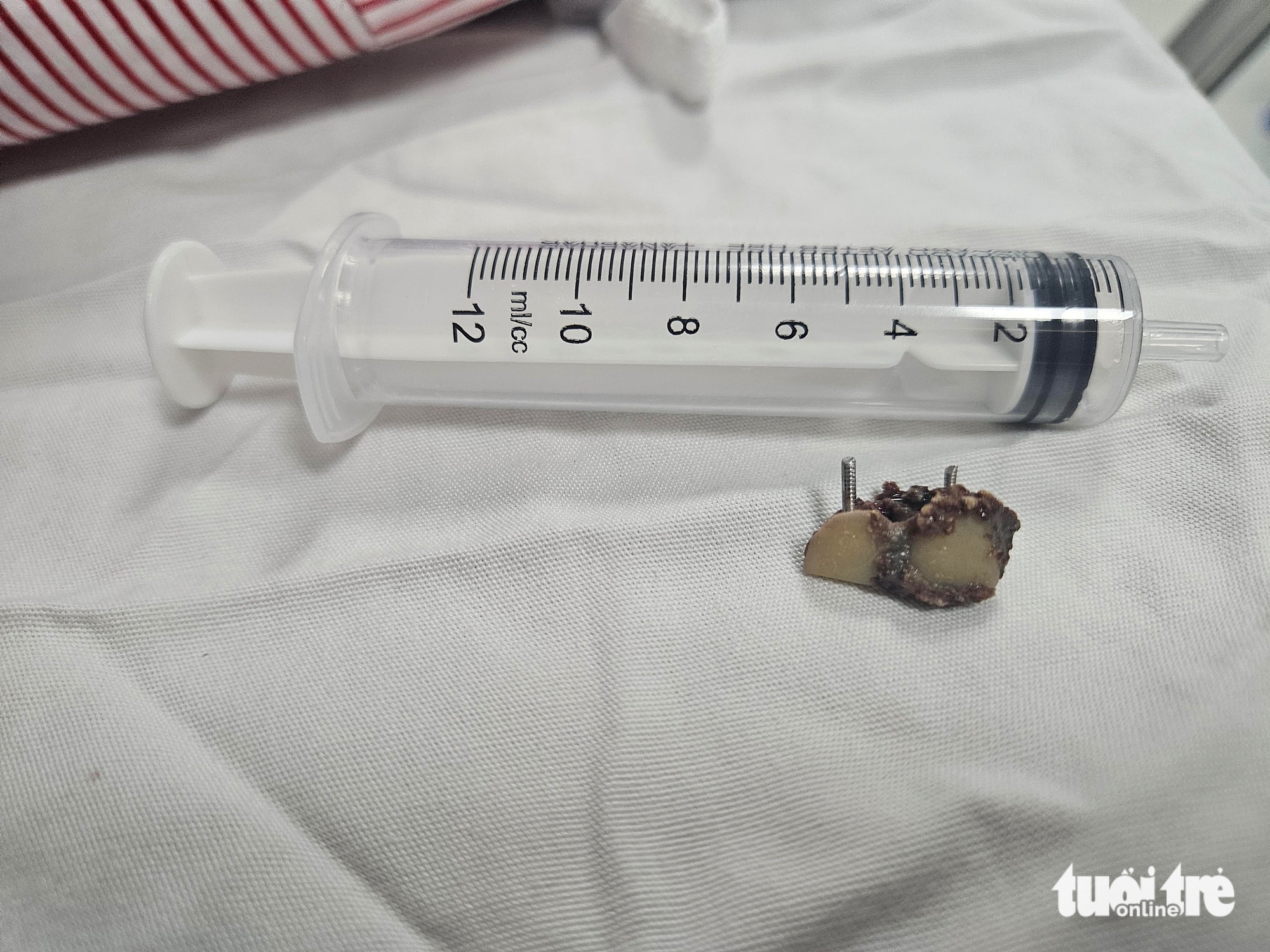 Bỗng dưng mất 2 chiếc răng, 20 năm sau bác sĩ phát hiện trong... phổi 2 Bỗng dưng mất 2 chiếc răng, 20 năm sau bác sĩ phát hiện trong... phổi - Ảnh 3.