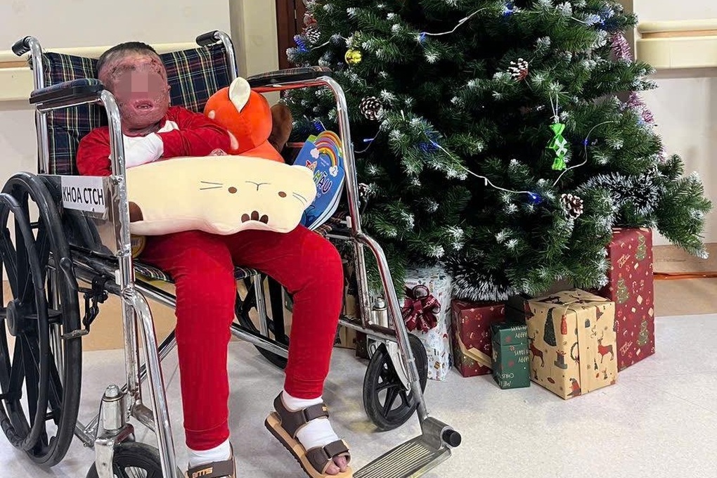 Bé trai 5 tuổi bị cha đốt xăng, bỏng 80% kiên cường vượt 96 ngày điều trị - 3