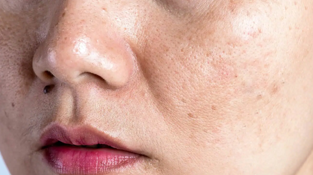 Từ nỗi ám ảnh lỗ chân lông đến làn da thông thoáng - khỏe từng ngày cùng 2% BHA của Paula’s Choice- Ảnh 2.