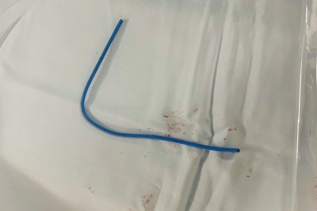 Ống thông truyền hóa chất bị đứt, trôi vào tim khiến người phụ nữ nguy kịch - 2