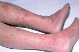 Hà Nội đã có ca mắc viêm não mô cầu, bác sĩ chỉ rõ dấu hiệu nhận biết bệnh