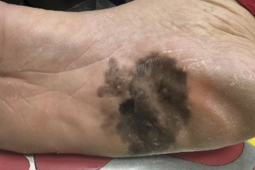 Đốm đen trên da có phải là dấu hiệu ung thư da?