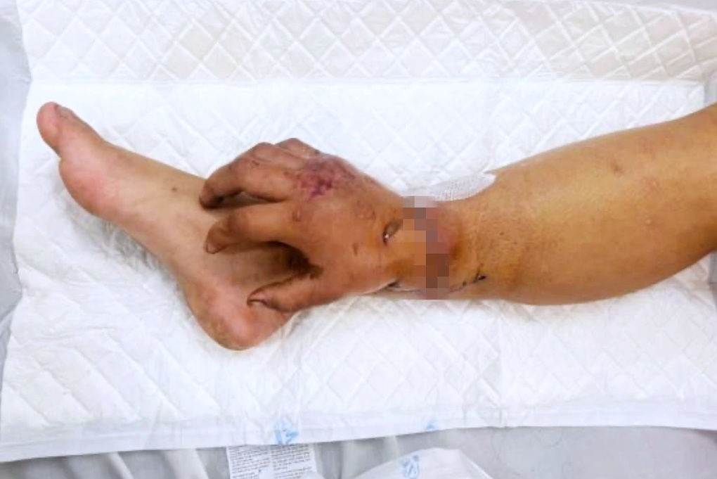 65 ngày làm nên phép màu cho thai phụ phải ghép tạm tay đứt lìa vào chân - 1