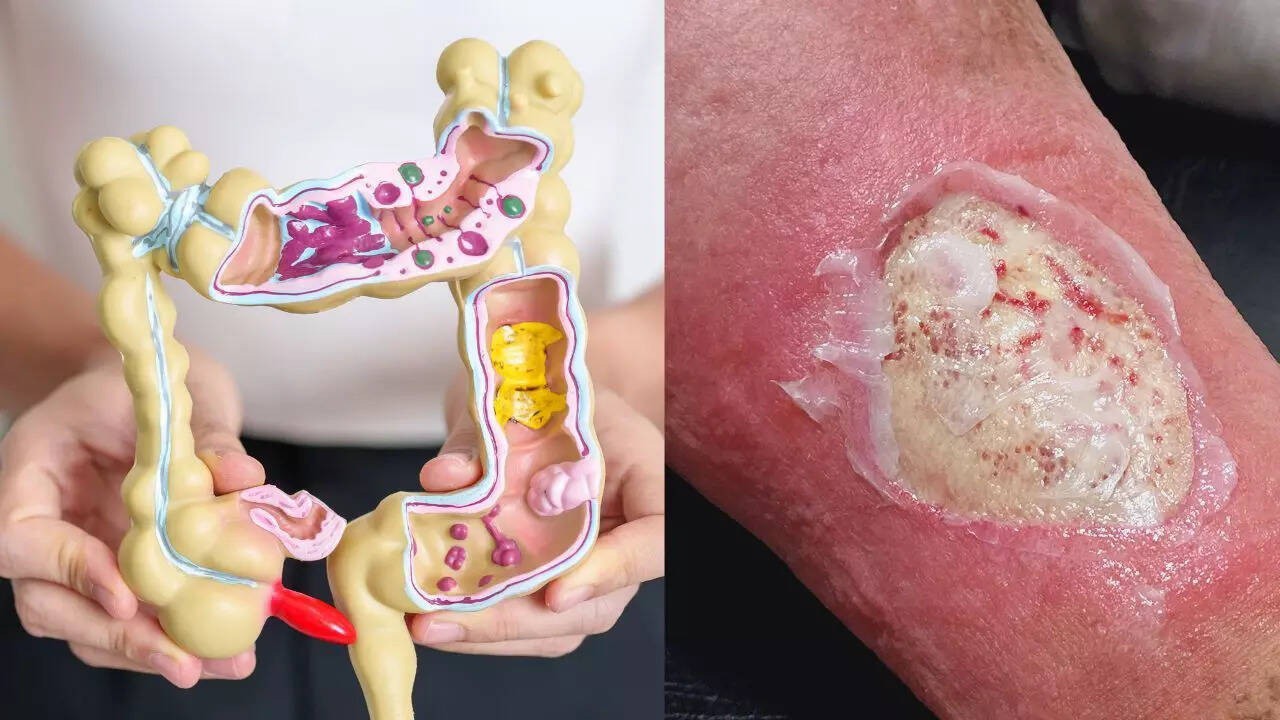 7 dấu hiệu trên da cảnh báo ung thư đại tràng, ai cũng cần biết 1 7 dấu hiệu trên da cảnh báo ung thư đại tràng, ai cũng cần biết - 1