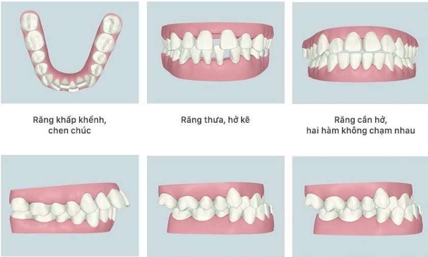 Bác sĩ cảnh báo sâu răng gia tăng ở người niềng răng 1 sâu răng - Ảnh 1.