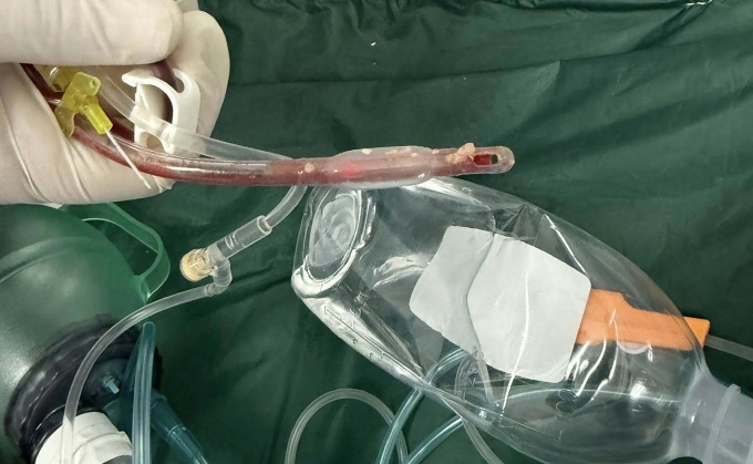 Thức ăn nghẹt dính vào ống nội khí quản sau khi hồi sinh tim phổi thất bại. Ảnh: Bác sĩ cung cấp