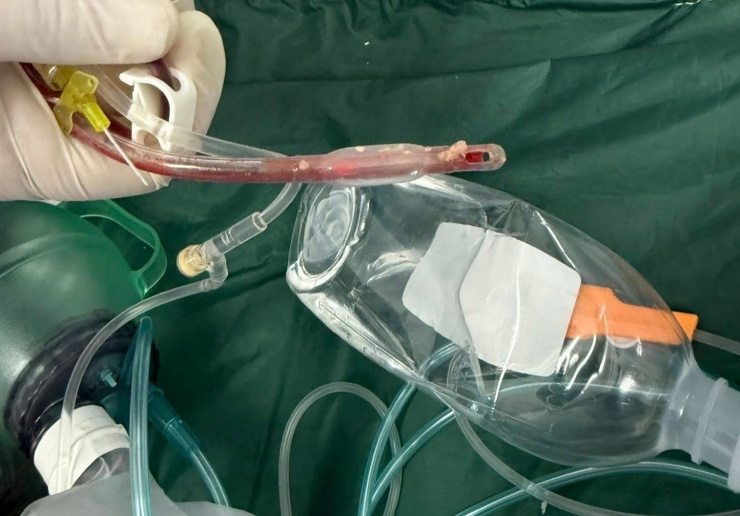 Bé gái 3 tuổi tử vong sau khi sặc thức ăn ở lớp 1 Thức ăn nghẹt dính vào ống nội khí quản của bệnh nhi. Ảnh: BSCC.