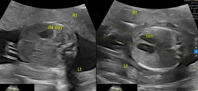 Ảnh siêu âm cho thấy tim và dạ dày của thai nhi nằm ở bên phải. Ảnh: Phòng khám Đa khoa Tâm Anh Quận 7