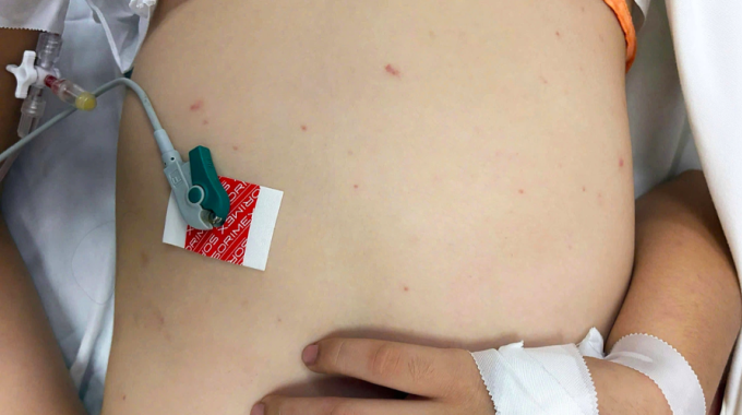 Trẻ mắc não mô cầu điều trị tại Bệnh viện TP Thủ Đức, TP HCM. Ảnh:Bệnh viện cung cấp