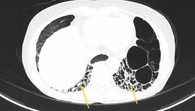 Ảnh CT phổi cho thấy bà Mỹ bị giãn phế quản và tổn thương mô kẽ dạng tổ ong hai đáy phổi và nhiều tổn thương khác. Ảnh: Bệnh viện Đa khoa Tâm Anh