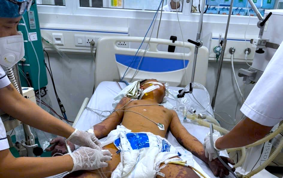 Thiếu niên 14 tuổi, ở Đắk Lắk bị sốc nhiễm trùng huyết não mô cầu tối cấp vào tháng 9/2025. Ảnh: Bệnh viện Đa khoa Trung tâm Gia Lai