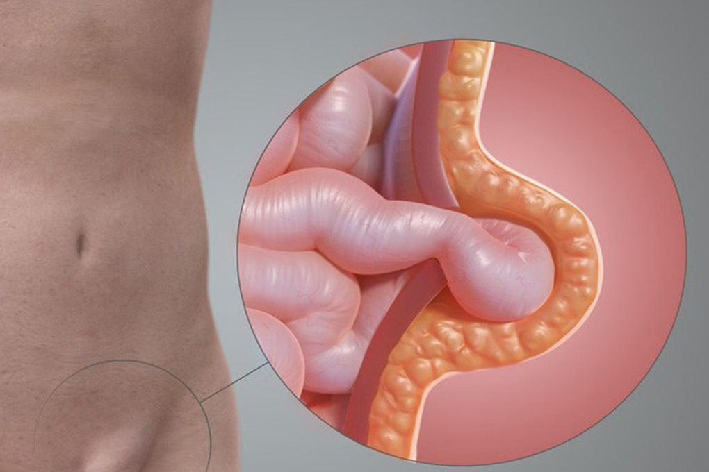 Căn bệnh ở vùng kín khiến người đàn ông suýt hoại tử - 1