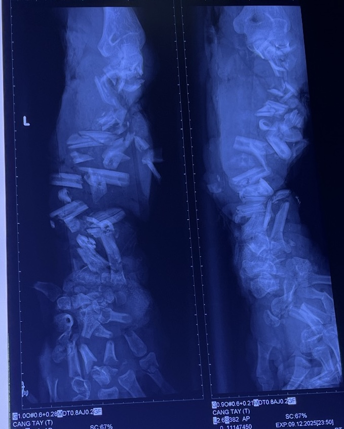 Ca tai nạn lao động thương tâm: Cánh tay bị máy nghiền vỏ dừa nghiền nát- Ảnh 1. Ca tai nạn lao động thương tâm: Cánh tay bị máy nghiền vỏ dừa nghiền nát- Ảnh 1.