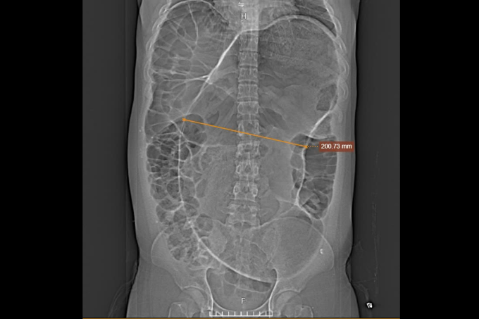 Chụp cắt lớp vi tính cho thấy đoạn đại tràng căng to (mũi tên vàng). Ảnh: Bệnh viện Đa khoa Tâm Anh