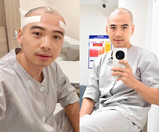 Chồng H'Hen Niê khoe diện mạo mới hậu "phẫu thuật", không còn hình ảnh tự ti khi đứng cạnh vợ hoa hậu 1 Chồng HHen Niê quyết định phẫu thuật cấy tóc hồi tháng 5/2025.