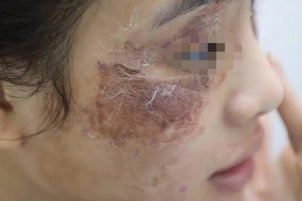 Cô gái gặp họa vì thoa kem mua trên mạng giá 600.000 đồng - 1