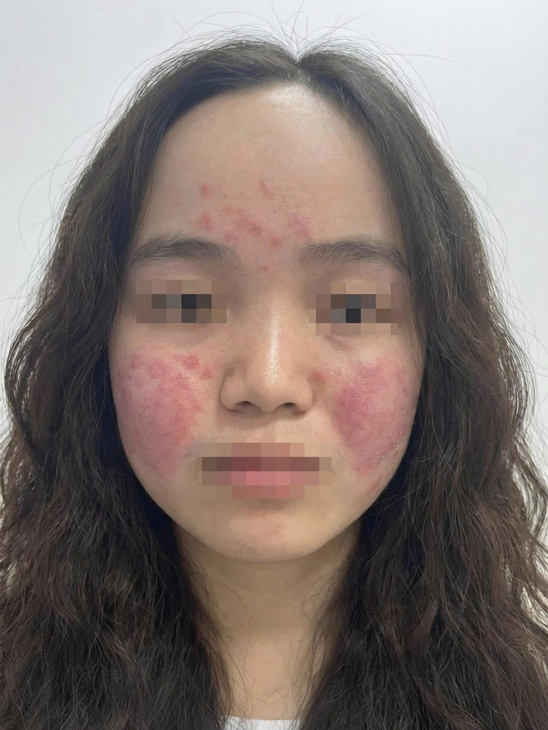 Cô gái trẻ đỏ rát toàn mặt vì ô nhiễm không khí, bác sĩ hướng dẫn cách bảo vệ da - Ảnh 1. ô nhiễm - Ảnh 1.