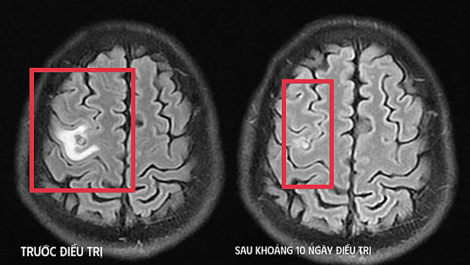 Hình ảnh chụp chiếu trước và sau khi điều trị. Ảnh: Bệnh viện cung cấp