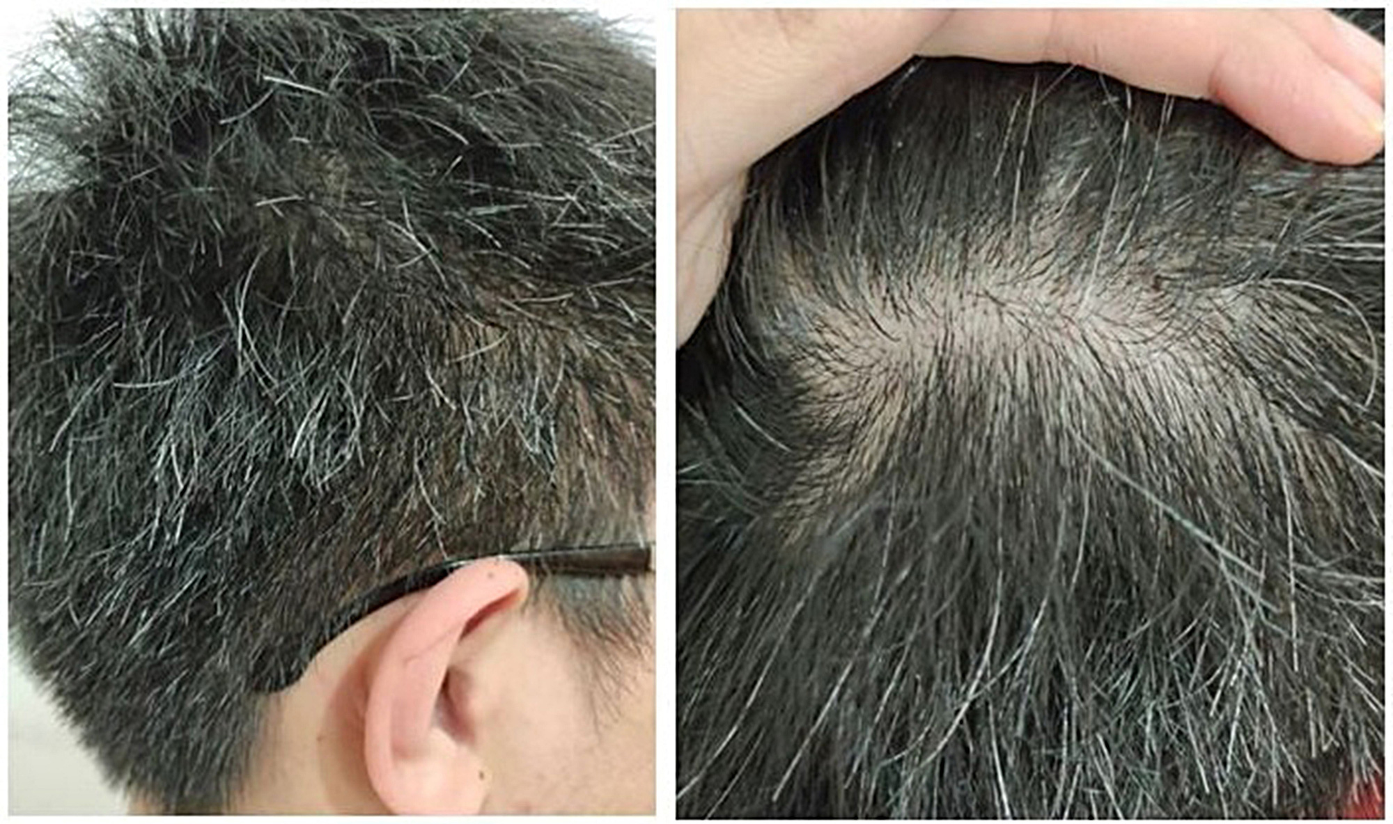 Có phải ‘tóc bạc nhiều là dấu hiệu của ung thư’? - Ảnh 1. tóc bạc - Ảnh 1.