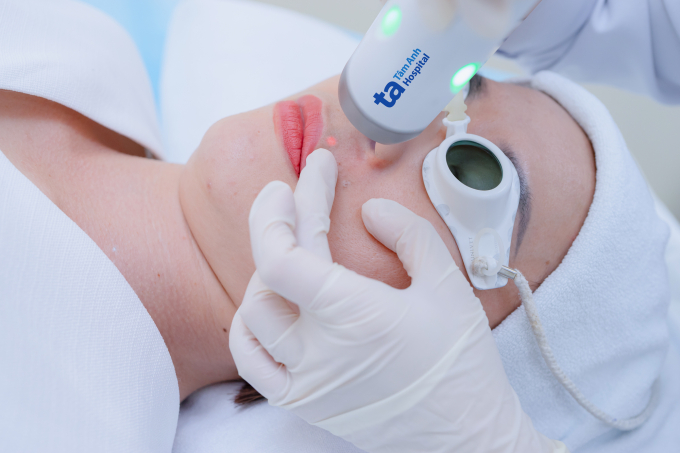 Bác sĩ sử dụng laser 6D triệt lông vùng ria mép. Ảnh minh họa: Bệnh viện Đa khoa Tâm Anh