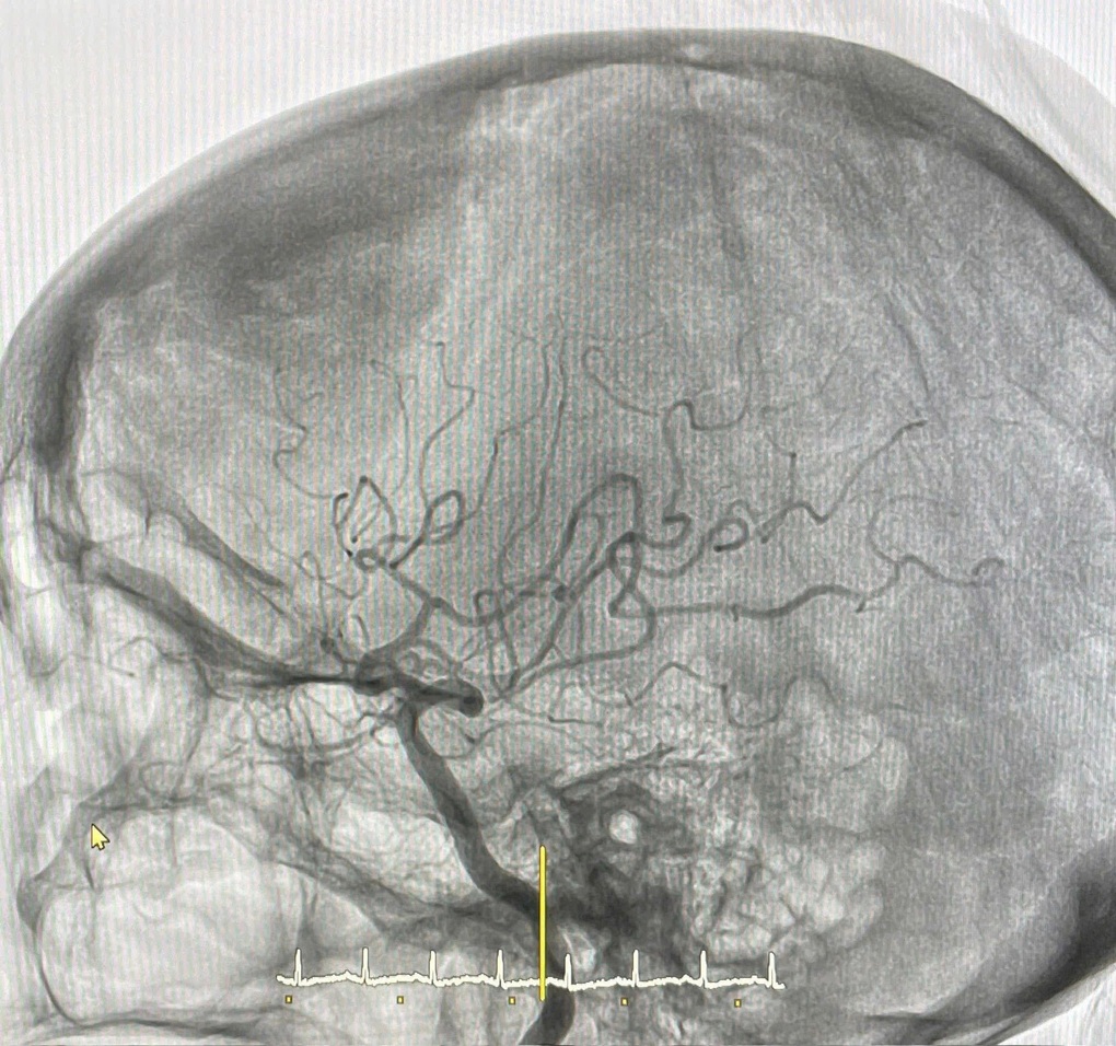 Cục máu đông khiến cụ bà suýt mất hàng triệu tế bào não mỗi phút - 1