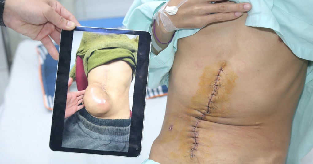 Cứu chàng trai khỏi khối u bụng khổng lồ như quả bóng, vỡ bất cứ lúc nào - 1