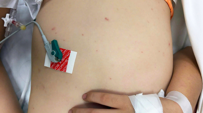 Trẻ mắc não mô cầu điều trị tại Bệnh viện TP Thủ Đức, TP HCM, tháng 4/2025. Ảnh: Bệnh viện cung cấp