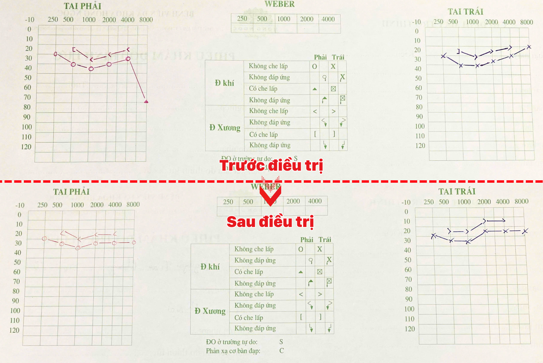 Đeo tai nghe suốt 5 giờ, nam thanh niên đột ngột mất thính lực 3 Kết quả đo thính lực đồ của bệnh nhân cải thiện rõ ràng một tuần điều trị