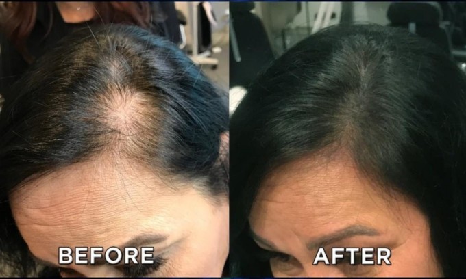 Điêu khắc đường chân tóc - cứu tinh cho tóc thưa mỏng 1 Điêu khắc chân tóc là một giải pháp bán vĩnh viễn dành cho những ai có tóc mỏng và rụng nhiều đặc biệt ở đường chân tóc hoặc ngôi rẽ tóc.