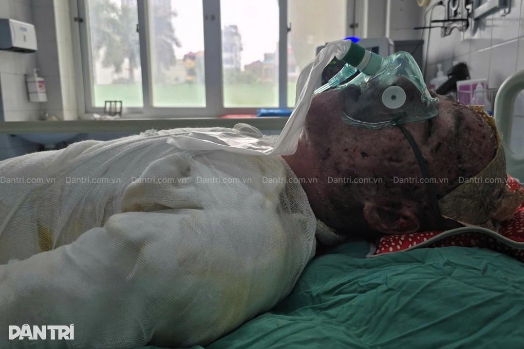 Gia cảnh kiệt quệ của người bố đơn thân bị bỏng khí gas mong được sống - 1