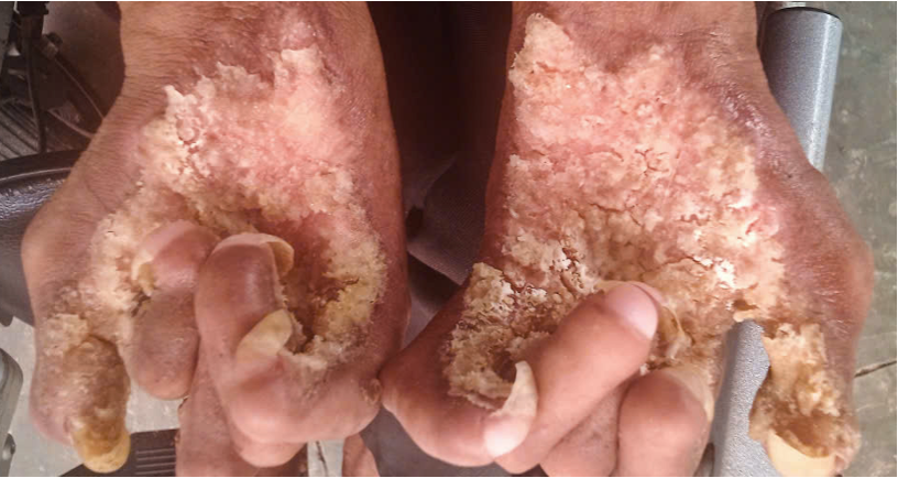 Giải mã bí ẩn bệnh “người cây” hiếm gặp tại Việt Nam - Ảnh 1.