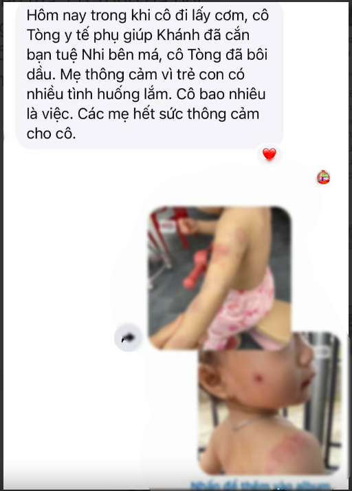 Bé hơn 2 tuổi có nhiều vết cắn, bầm tím: Giáo viên nói 