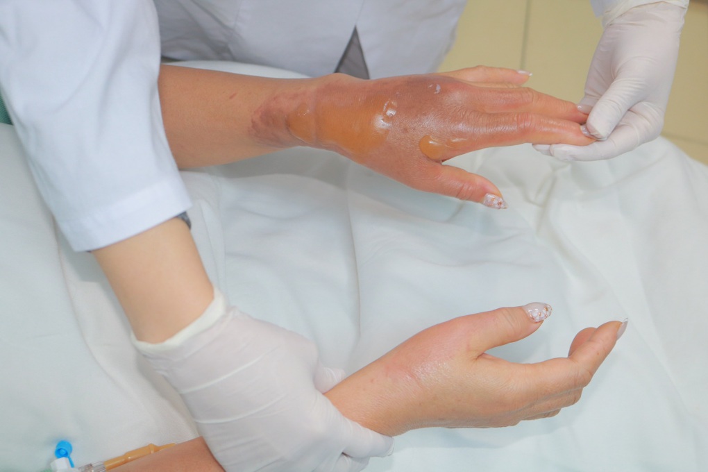 Hà Nội: Hóa chất thông bồn cầu phát nổ, người phụ nữ bỏng nặng - 1