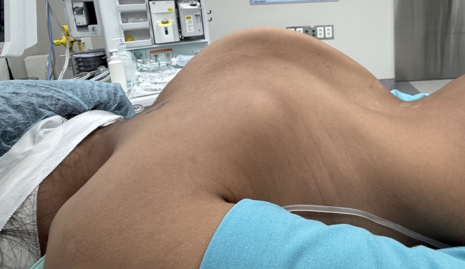 Góc cong vẹo cột sống của bé Tuyết trước mổ. Ảnh: Bác sĩ cung cấp