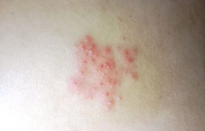 Các nốt mụn nước ở lưng người mắc zona thần kinh. Ảnh: Diệu Linh