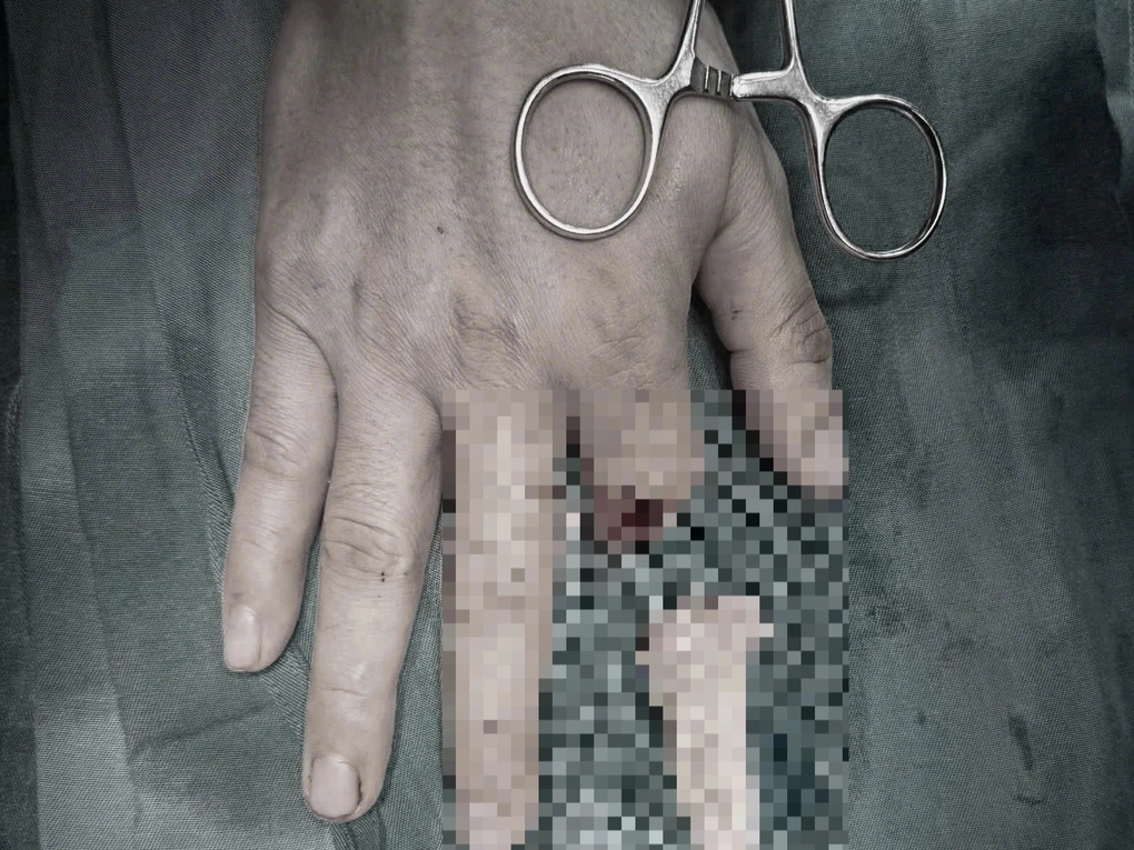 Lần đầu tiên tại Việt Nam, ngón tay đứt rời 25 giờ được nối thành công - 1