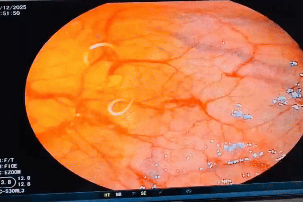 Món nhiều người mê đưa ổ giun vào bụng người phụ nữ - 1