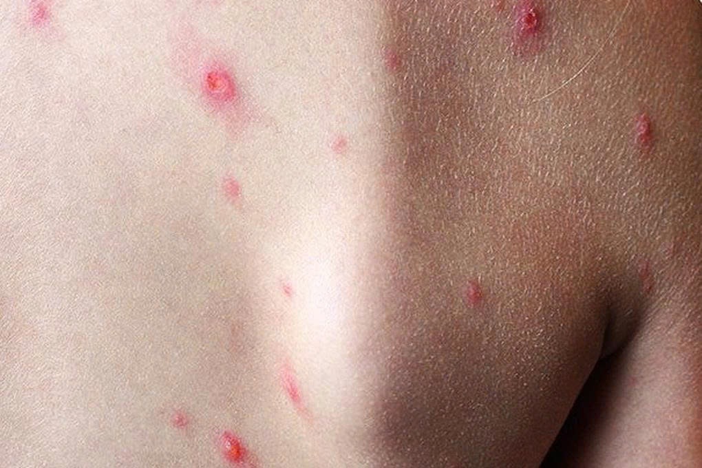 Một tỉnh phía Nam ghi nhận ca mắc đậu mùa khỉ đầu tiên - 1