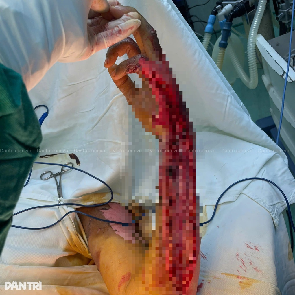 Nam sinh 14 tuổi nguy cơ phải cắt bỏ cả hai tay sau cú điện giật kinh hoàng - 1